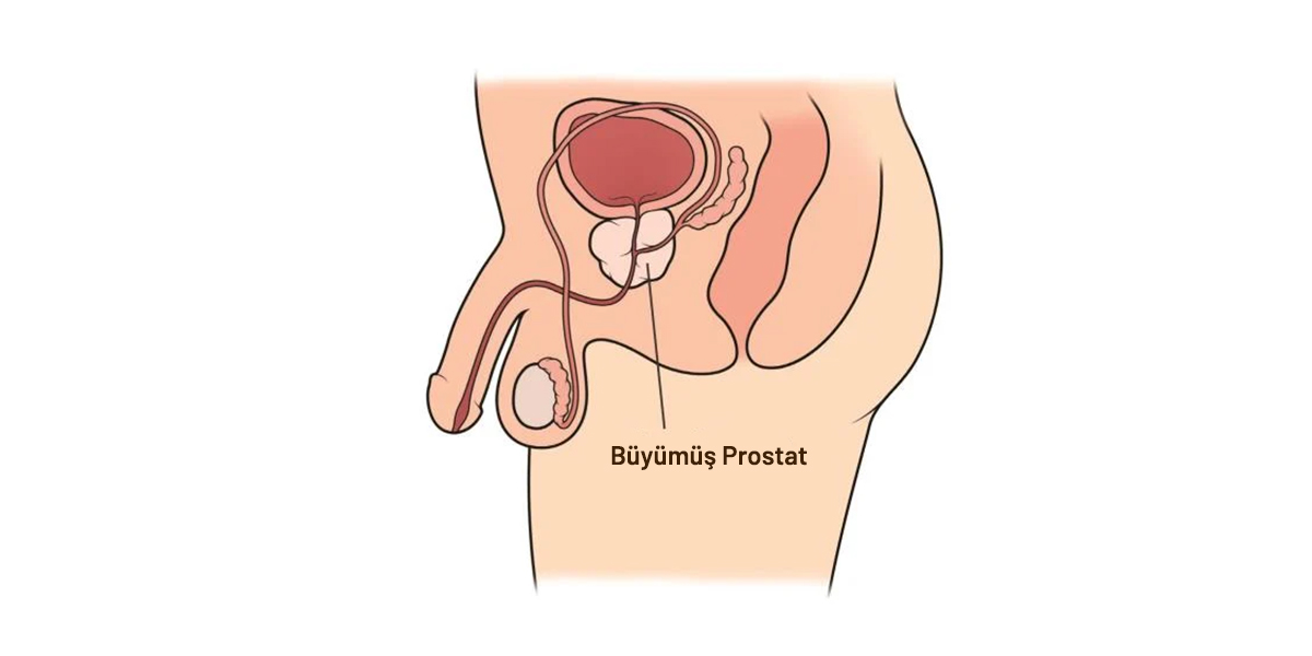 HoLEP İle Prostat Ameliyatı Nasıl Yapılır?